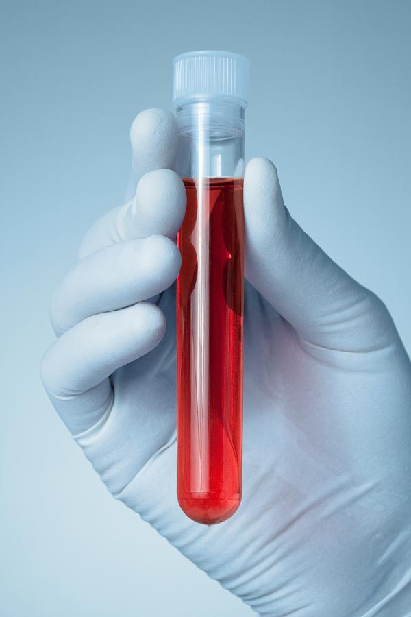 Autoimmune-Treatment Close up of a gloved hand holding a vial of red liquid, representing Morgan Burns, APRN's comprehensive autoimmune disorder treatment in Central Florida.