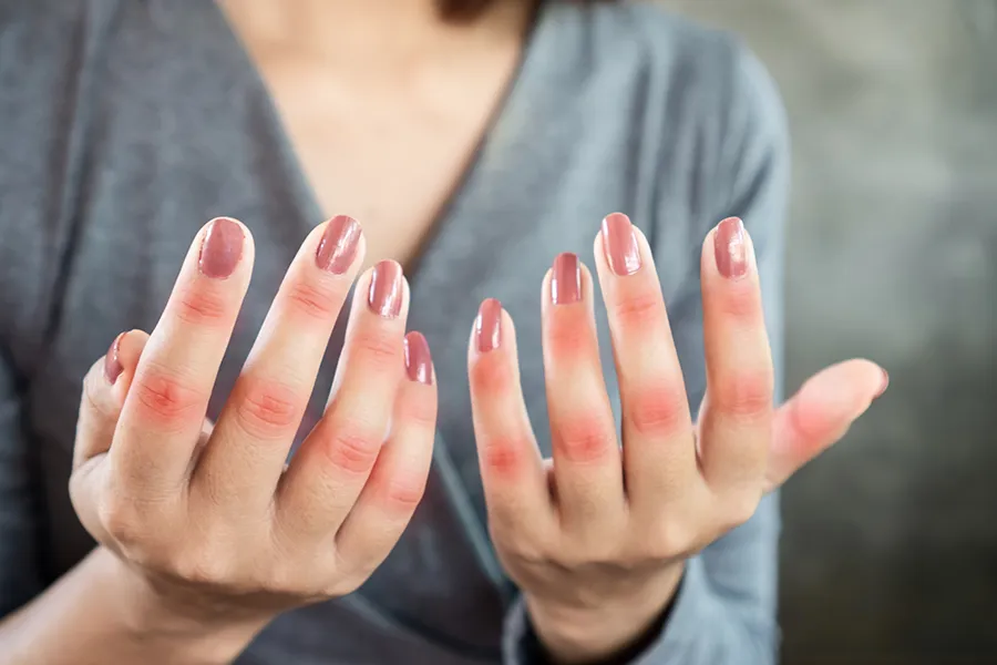 Lupus-Clinic Close-up of the hands of a woman in a gray shirt, with swollen, red knuckles. Get treatment for Lupus from Morgan Burns, APRN in Central Florida.