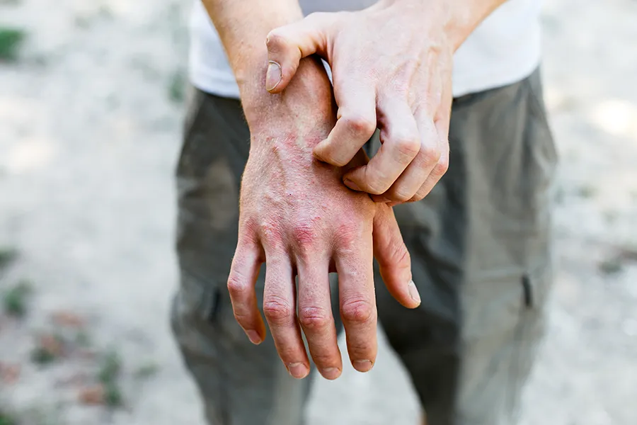 Psoriasis-Clinic Close-up of a man scratching his hands while experiencing Psoriasis. Get care for Psoriasis from Morgan Burns, APRN in Central Florida.