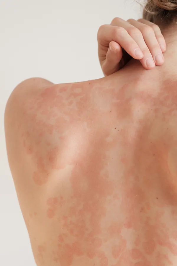 Psoriasis-Treatment The back and shoulder of a woman experiencing Psoriasis. Get treatment for Psoriasis from Morgan Burns, APRN in Central Florida.
