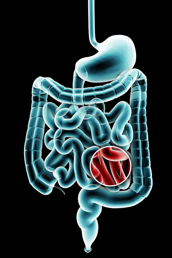 Ulcerative-Colitis-Treatment 3D illustration of the digestive system in blue tones, with an area of discomfort in red tones. Get treatment for Ulcerative Colitis from Morgan Burns, APRN in Central Florida.